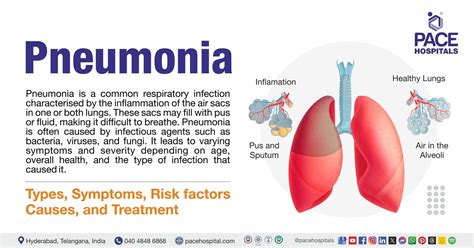 How Dangerous Is Walking Pneumonia