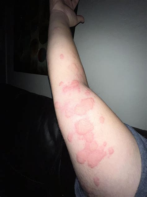 How Dangerous Is Xolair Reddit