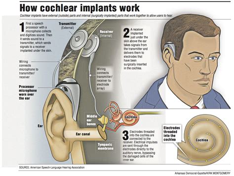 How Do Cochlear Implants Work