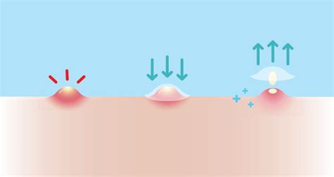 How Do Pimple Patches Work