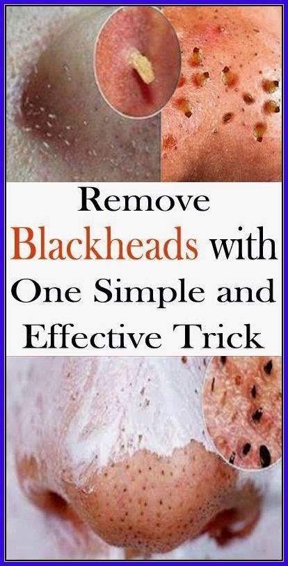 How Do You Remove Blackheads