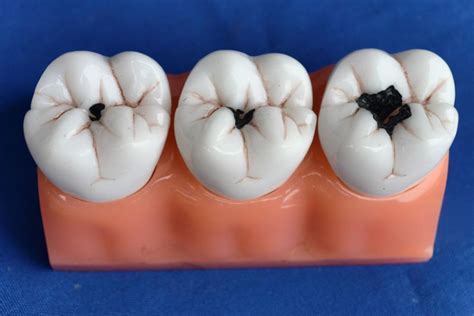 How Does A Cavity Look Like