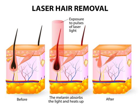 How Does Hair Laser Work
