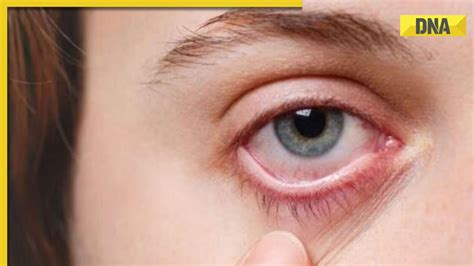 How Does Pink Eye Spread