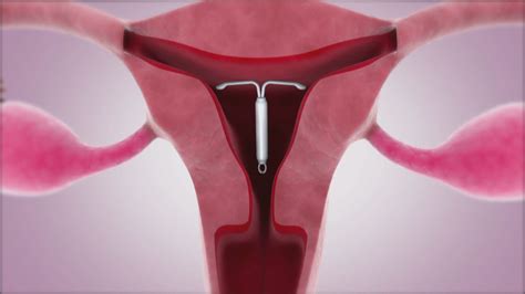 How Effective Is An Iud