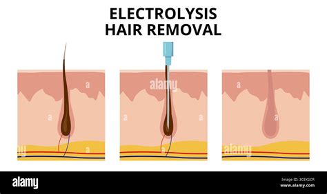 How Expensive Is Electrolysis Hair Removal