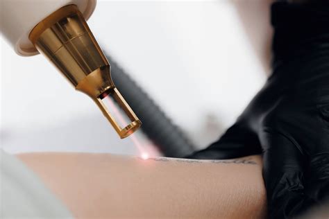 How Expensive Is Laser Tattoo Removal