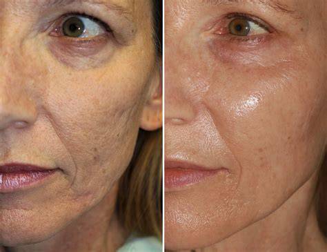How Expensive Is Microneedling