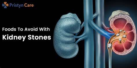 How Fast Can Kidney Stones Grow