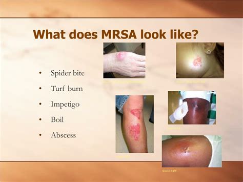 How Fast Can Mrsa Kill You