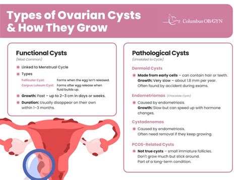 How Fast Can Ovarian Cysts Grow
