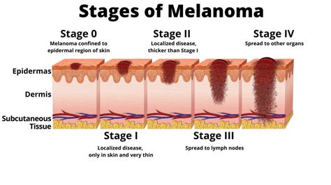 How Fast Does Melanoma Grow
