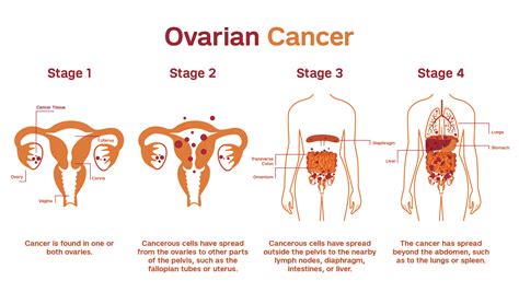 How Fast Does Ovarian Cancer Grow