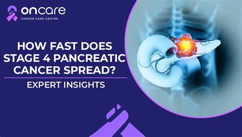 How Fast Does Pancreatic Cancer Spread