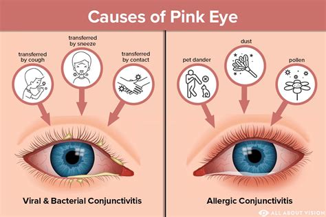 How Fast Does Pink Eye Go Away