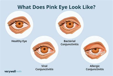 How Fast Does Pink Eye Show Up