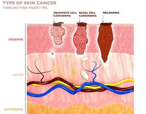 How Fast Does Squamous Cell Carcinoma Spread