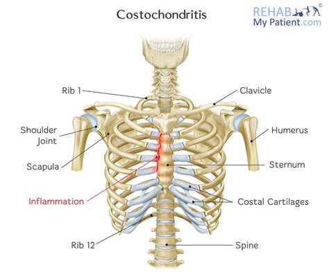 How I Cured My Costochondritis