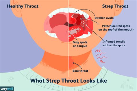 How Is Strep Throat Transmitted