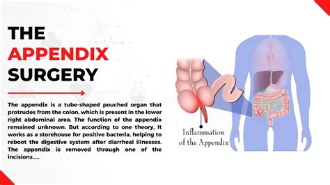 How Long Are Appendix Surgeries