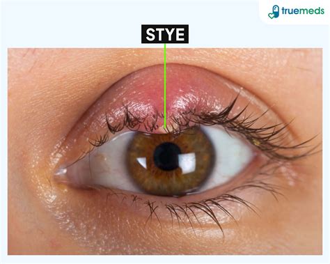 How Long Do Styes Last