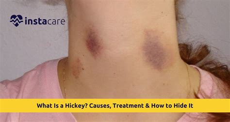 How Long Does Hickey Last