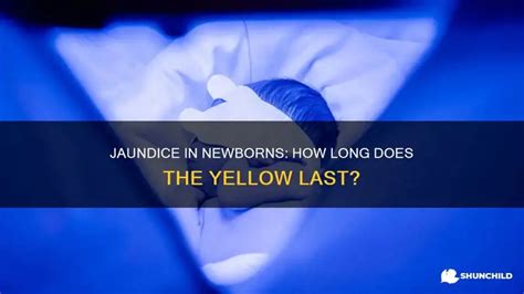 How Long Does Jaundice Last In Newborns