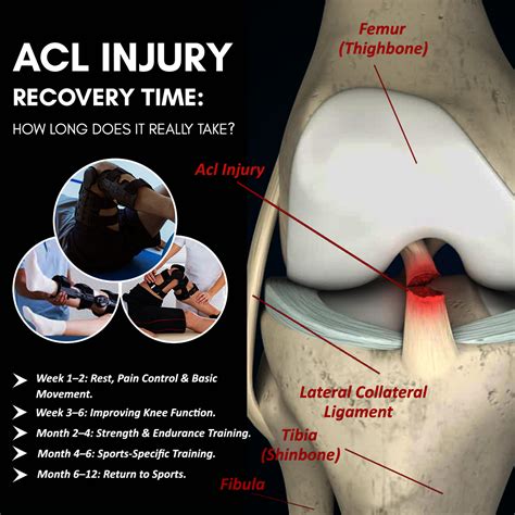 How Long Is Acl Recovery