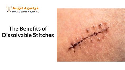 How Long Until Dissolvable Stitches Dissolve