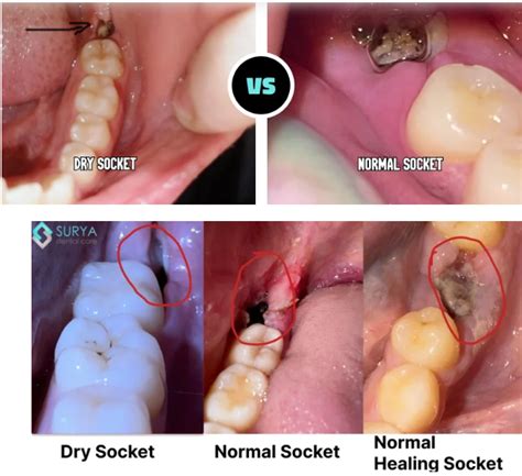 How Long Until Dry Socket Goes Away