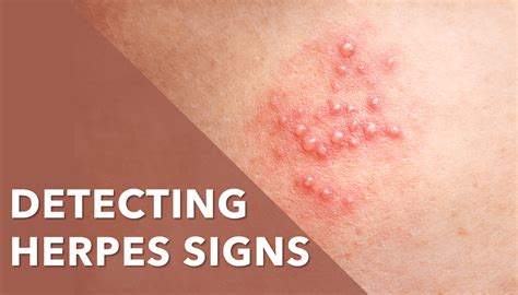 How Long Until Herpes Symptoms Appear