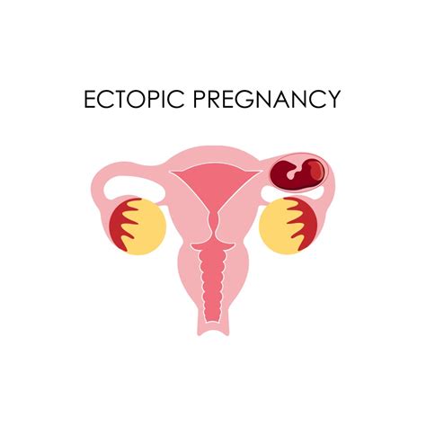 How Rare Is Ectopic Pregnancy