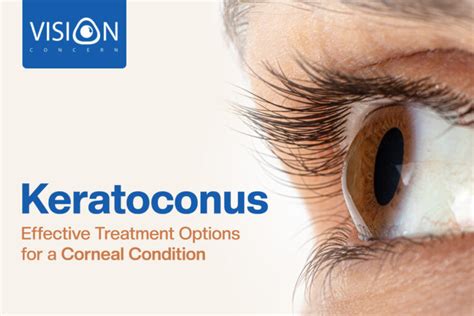 How Rare Is Keratoconus