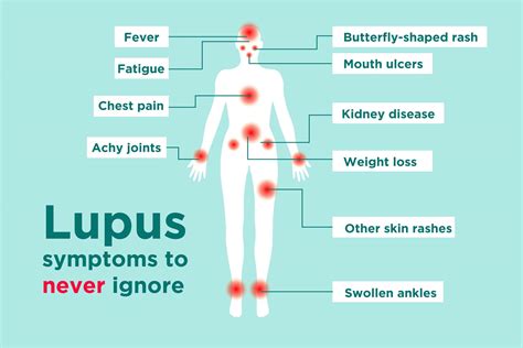 How Rare Is Lupus