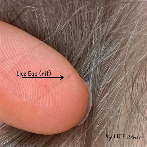 How Small Is Lice Egg