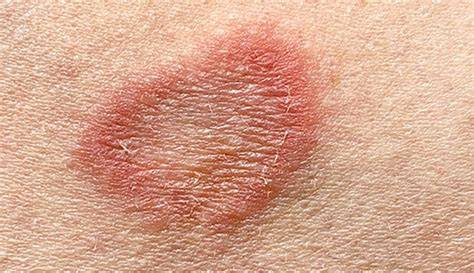 How Small Is Ringworm