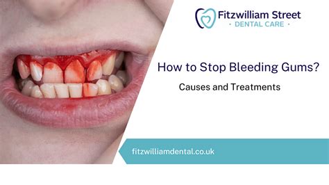 How To Avoid Bleeding Gums