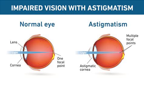 How To Correct Astigmatism