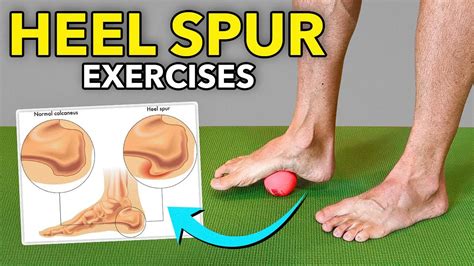 How To Cure Calcaneal Spur