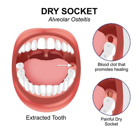 How To Cure Dry Socket