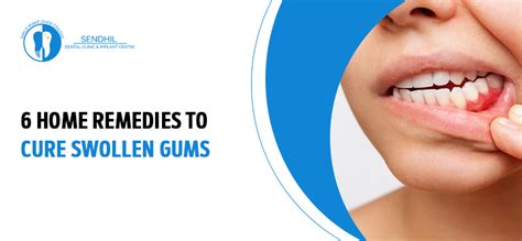 How To Cure Swollen Gums