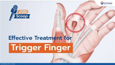 How To Cure Trigger Finger