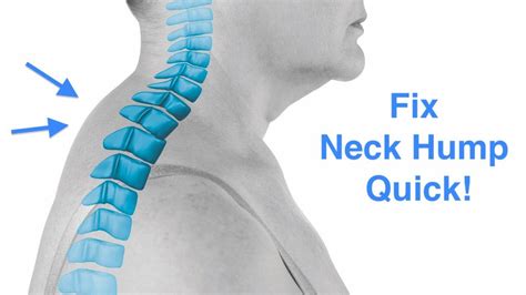 How To Fix Neck Hump