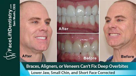 How To Fix Overbite Naturally