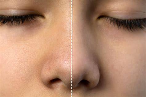 How To Make Pores Smaller