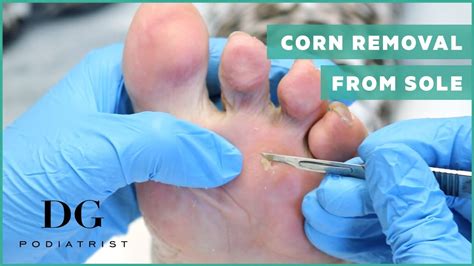 How To Remove A Corn