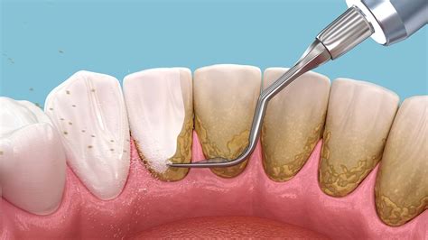 How To Remove Dental Plaque