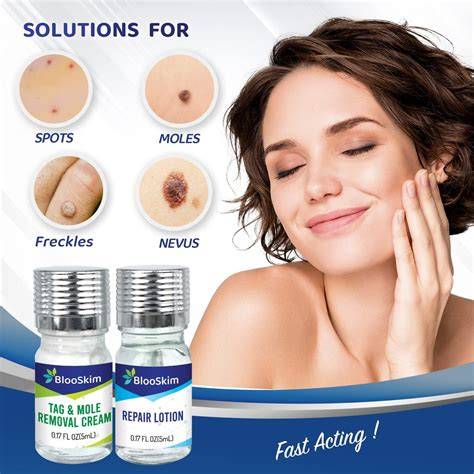How To Remove Moles