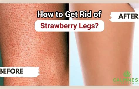 How To Remove Strawberry Legs