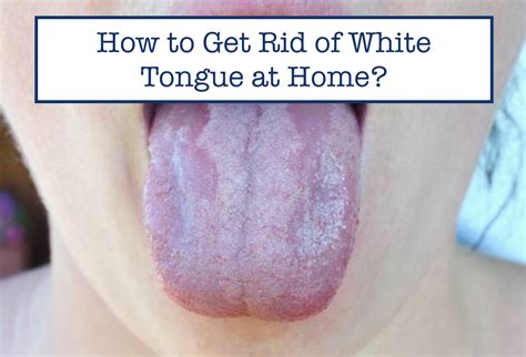 How To Remove White Tongue